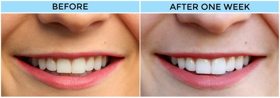 smile brilliant before and after
